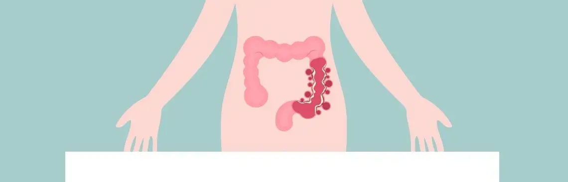 Artikel/IBS-D Image of IBS-D